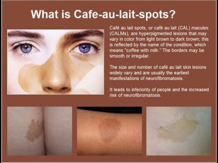Can café-au-lait spots get bigger?