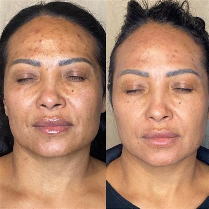 Can microdermabrasion make scars worse?