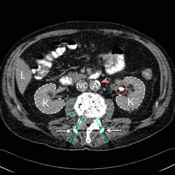 Can scar tissue look like a mass on a CT scan?