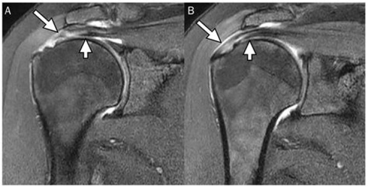 Can you have an MRI with a total shoulder replacement?