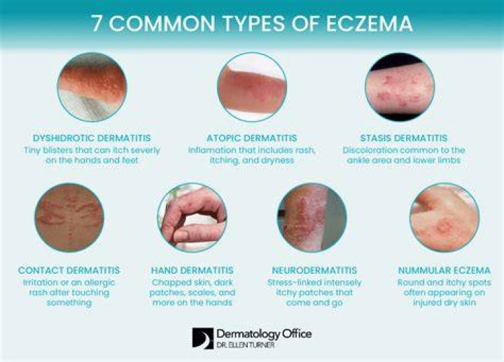 Does sun affect eczema?