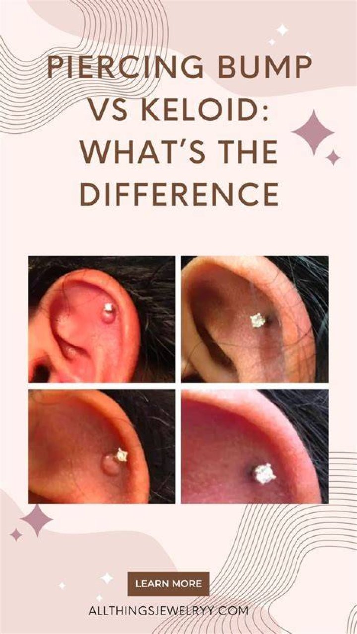 How common are keloids from ear piercings?