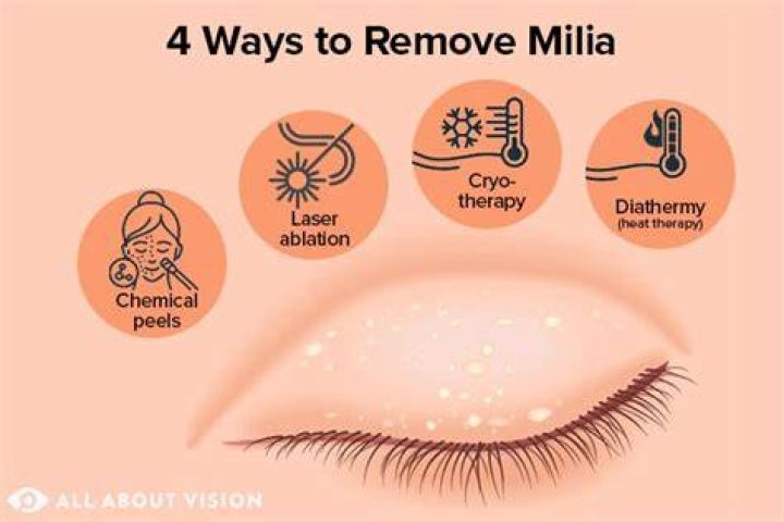 How do you get rid of a milia bump?