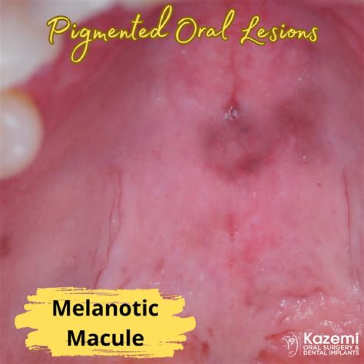 How do you get rid of Melanotic oral macule?