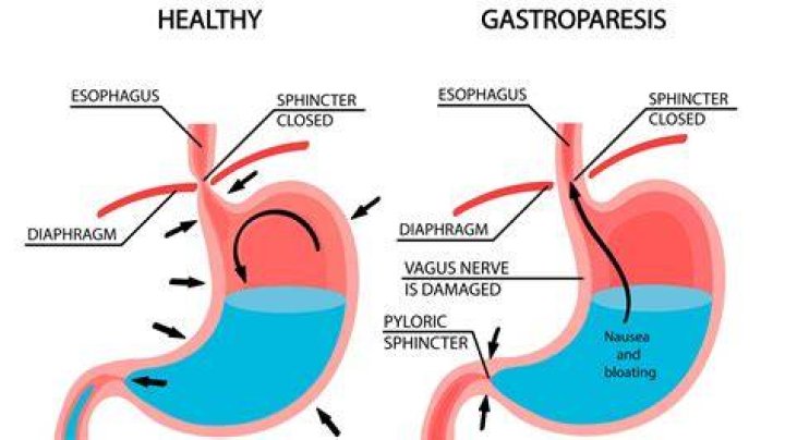 How long does it take gastroparesis to heal?