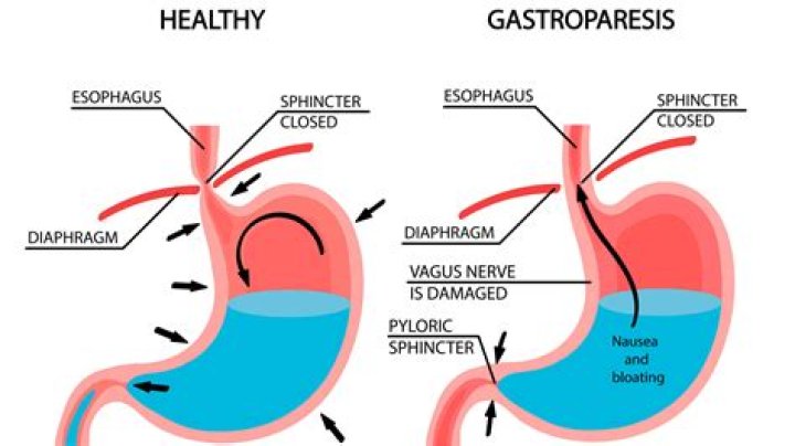 Is gastroparesis a big deal?