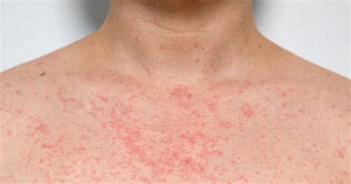 Should I see a doctor for a rash?