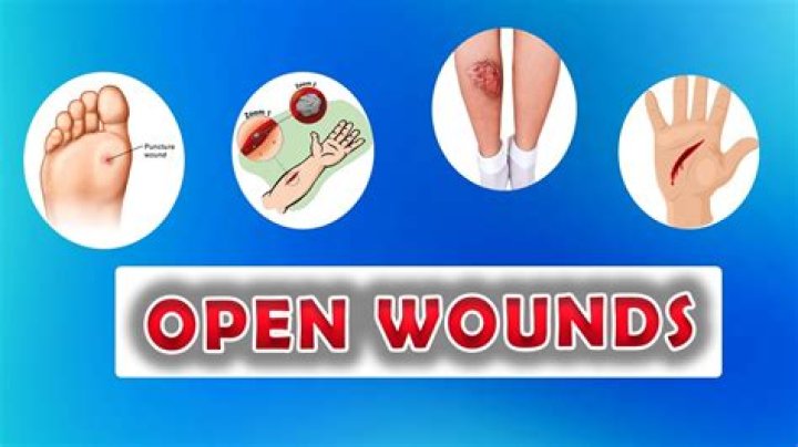 What can be put on an open wound?