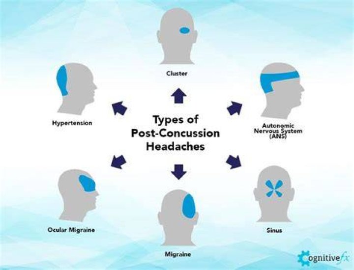What does a concussion headache feel like?