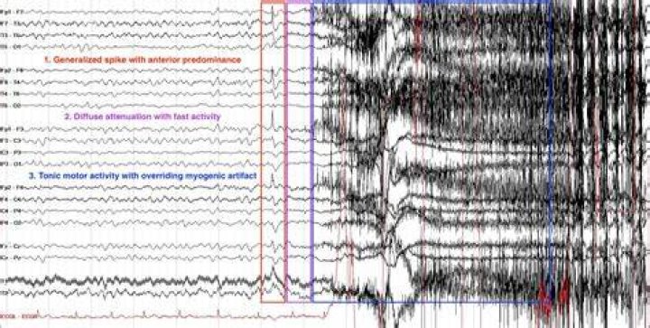 When do you need an EEG after a seizure?
