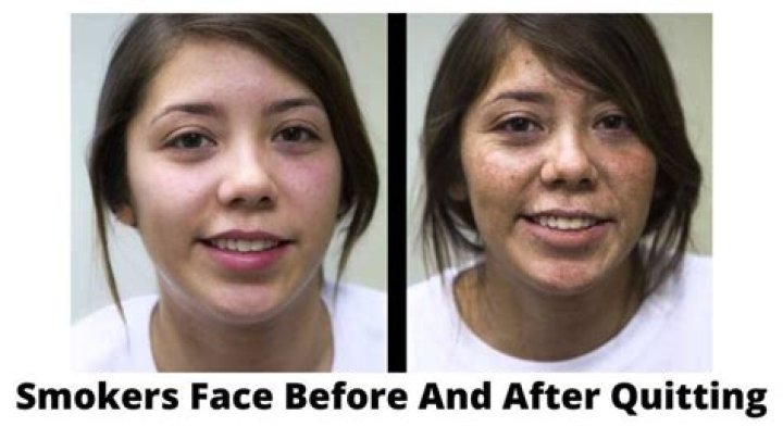 When does skin look better after quitting smoking?