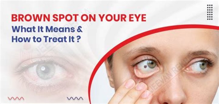 Why do I have a brown spot on my eye?